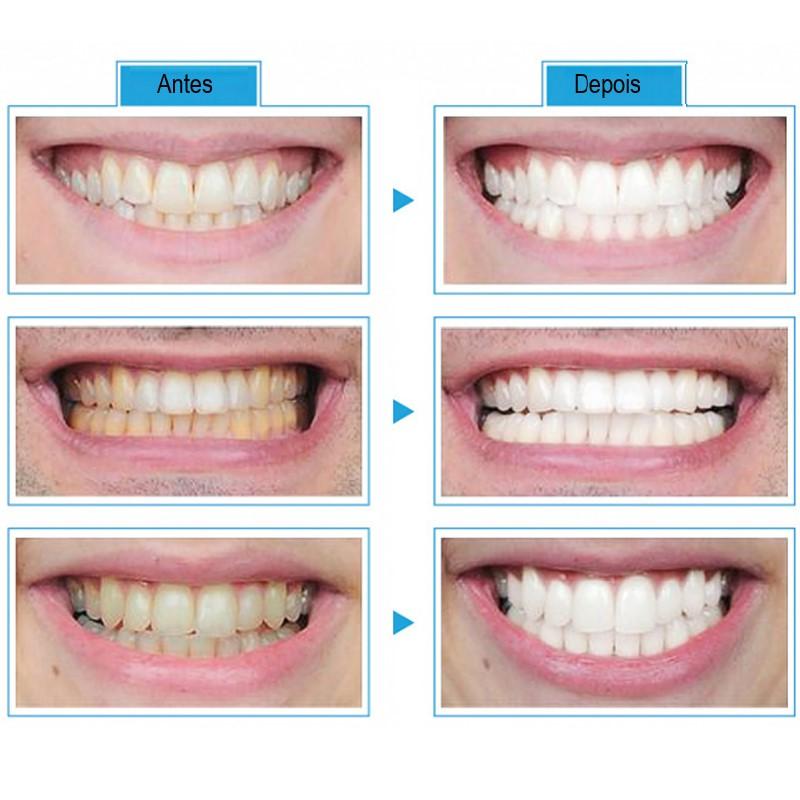 Clareador Portátil de Dentes